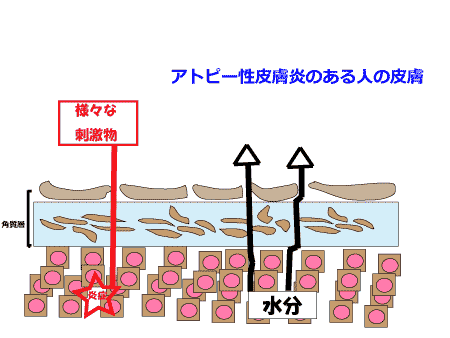 アトピー性皮膚炎のある人の皮膚
