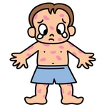 食物アレルギー