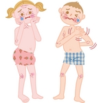 子供のアトピー
